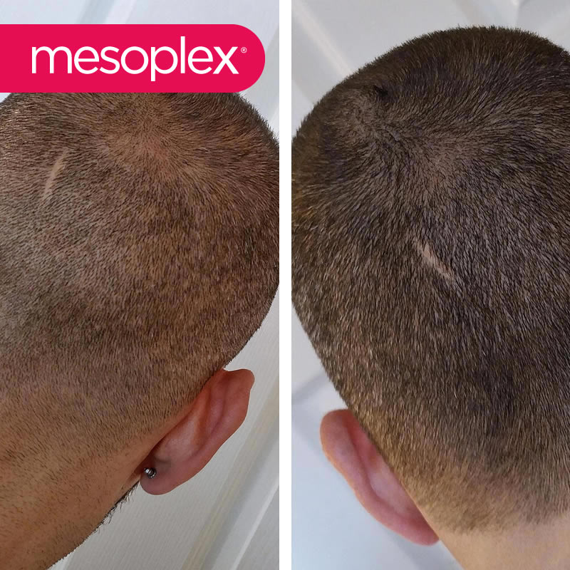 Mesoplex Resmi Satış Sitesi